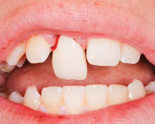 после чистки каналов болит зуб при нажатии 