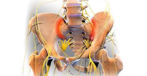 сакроилеит что это за болезнь 