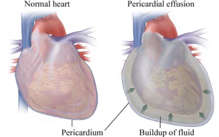 жидкость в перикарде