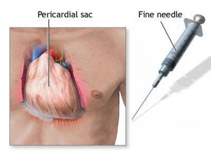 полость перикарда