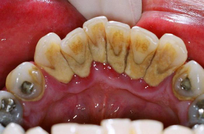 можно ли курить после удаления зуба отзывы