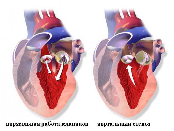 Стеноз аортального клапана