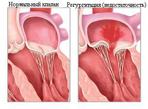 Недостаточность аортального клапана