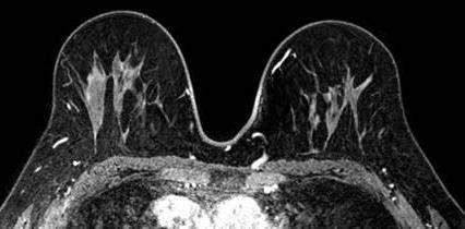 что показывает мрт молочной железы