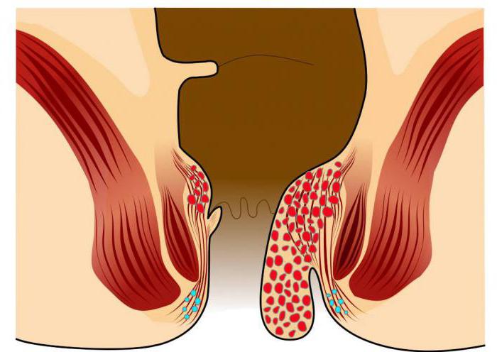 геморрой кровит что делать