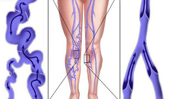 профилактика варикоза вен на ногах