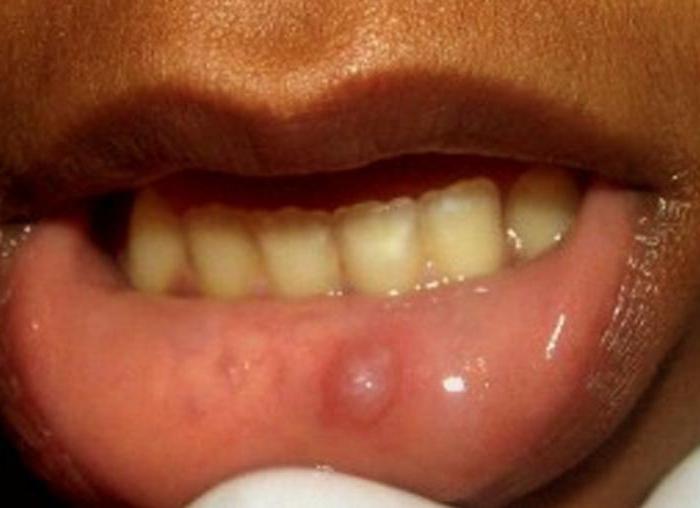 ретенционная киста нижней губы лечение