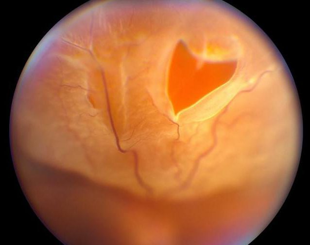 разрывы сетчатки глаза