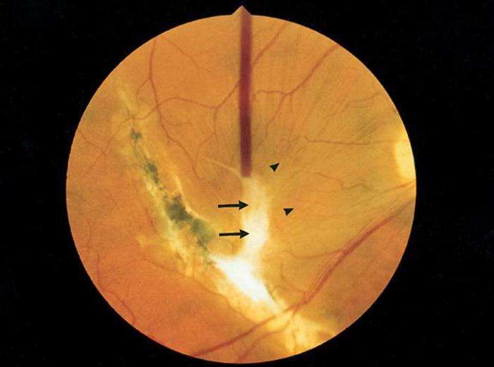 разрыв сетчатки глаза лечение