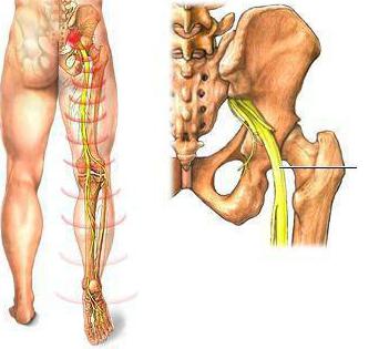 боль в области ягодицы отдающая в ногу