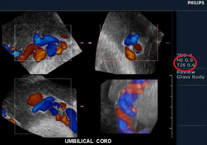 допплерометрия плода расшифровка 