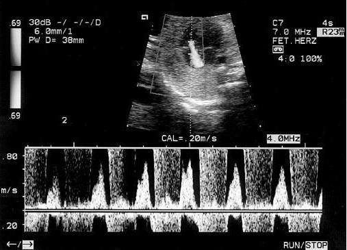 допплерография при беременности 