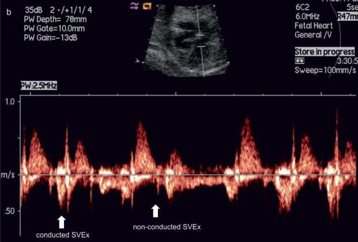 допплерометрия плода норма 