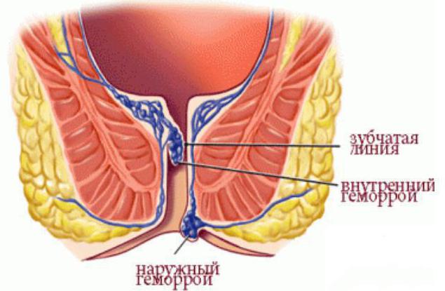 лечение геморроя лекарственные препараты