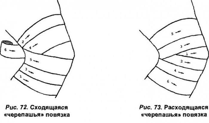 черепашья повязка сходящаяся и расходящаяся