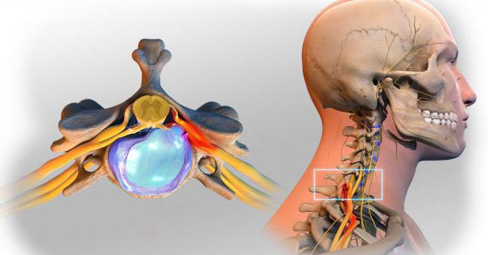 грыжи шейного отдела позвоночника симптомы лечение упражнения