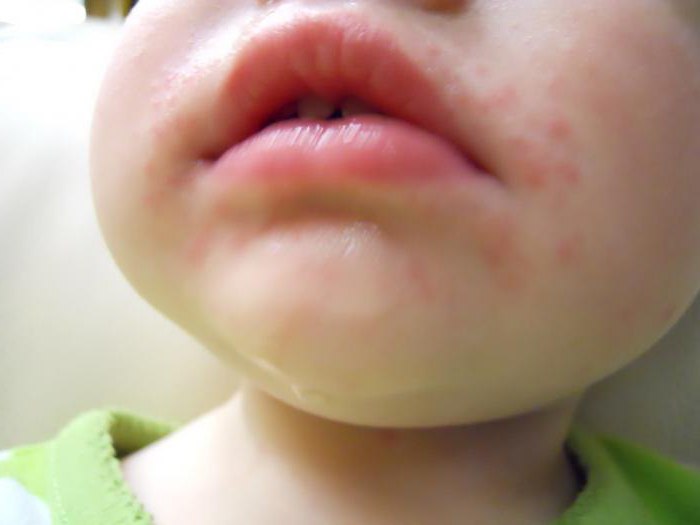 Аллергия на клубнику у ребенка симптомы