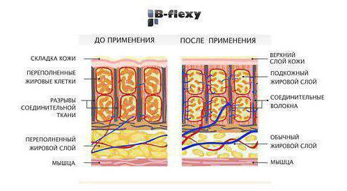 b flexy вакуумный массаж отзывы