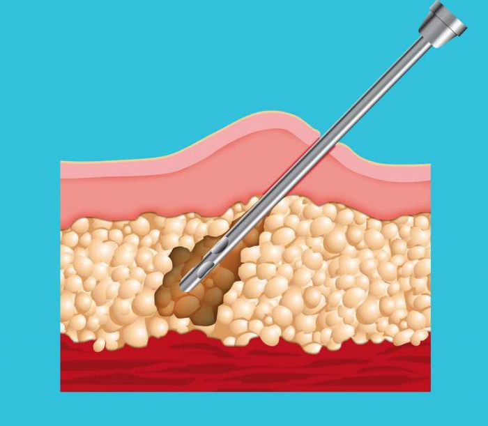 ультразвуковая липосакция