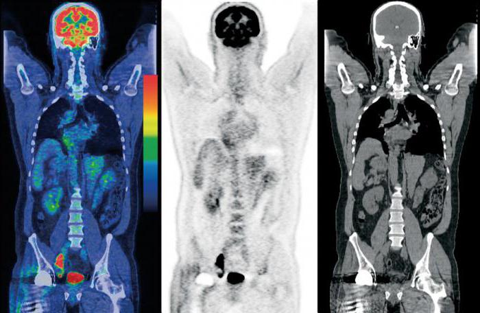 ПЭТ-КТ всего тела