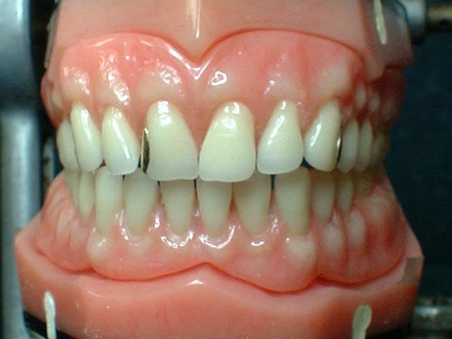 акриловые зубные протезы 