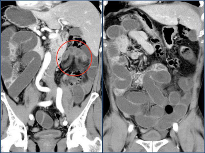 компьютерная томография кишечника отзывы