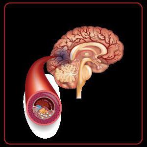 ишемический инсульт головного мозга прогноз