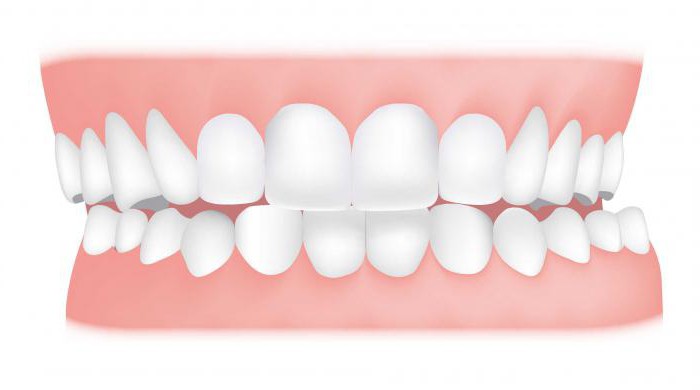 патологические виды прикуса 
