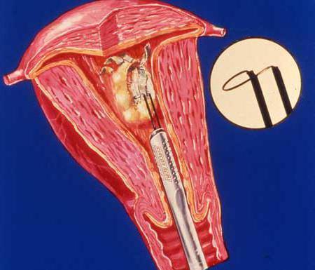 гиперплазия эндометрия при климаксе выскабливание отзывы 