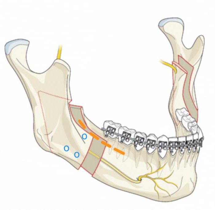 альвеолярный отросток нижней челюсти