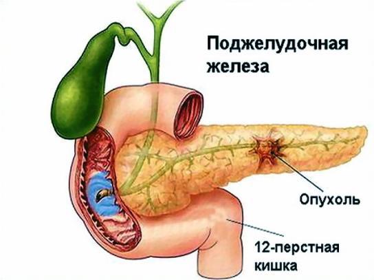 онкомаркер ca 19 9