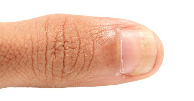 Перекись водорода от грибка ногтей: отзывы, особенности применения и эффективность