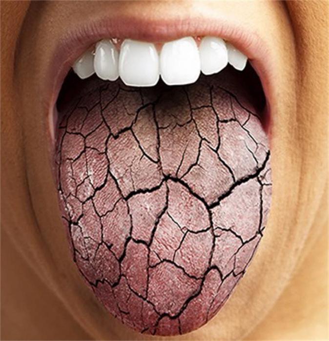 Почему пересыхает во рту: возможные причины и способы лечения