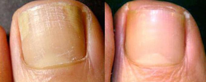 фундизол от грибка ногтей фото до и после 