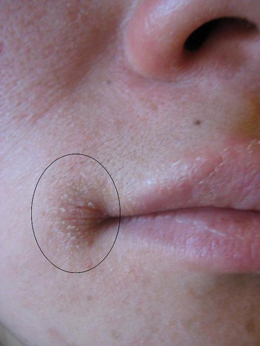 Почему в уголках губ болячки появляются, чем их лечить?