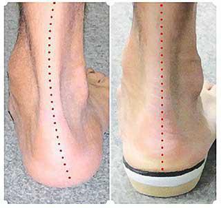  ортопедические стельки на заказ