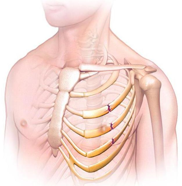 Что делать, если сломано ребро: симптомы, профилактика и особенности лечения