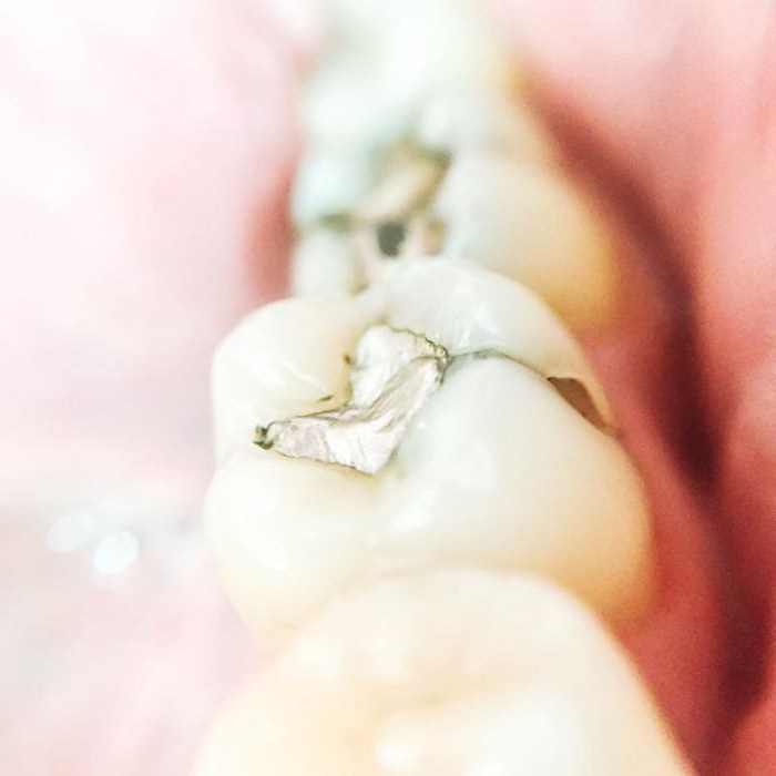 Что такое амальгама в стоматологии?