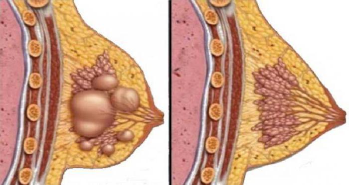 диффузный фиброаденоматоз молочных желез лечение