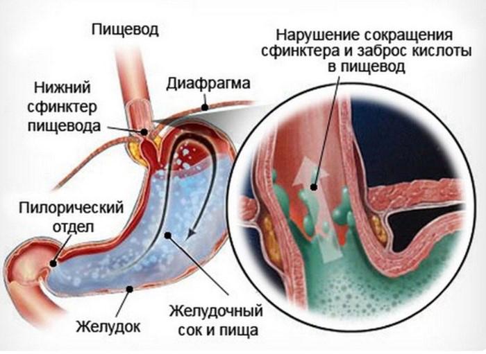 рефлюкс эзофагит симптомы и лечение 