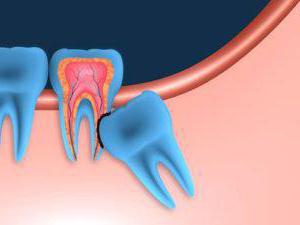 растет зуб мудрости болит десна что делать