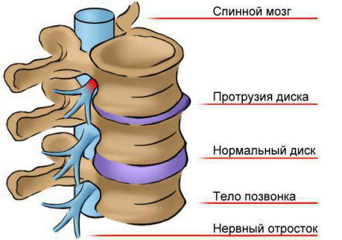дорзальные протрузии межпозвонковых дисков