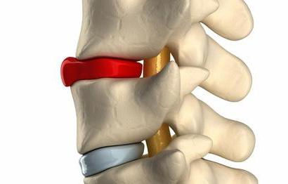 дорзальная протрузия диска что это такое
