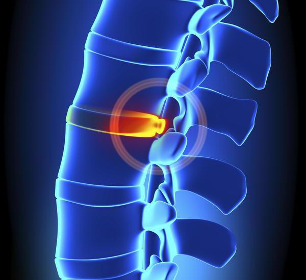 дорзальные протрузии дисков поясничного отдела