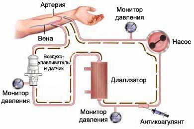 аппарат для диализа