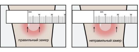 результат пробы манту у детей