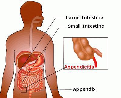 где находится аппендикс у человека фото