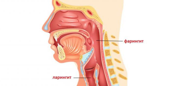 чем отличается ларингит от фарингита у детей 