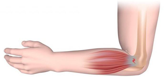 латерального эпикондилита