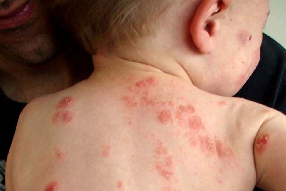 проявления аллергии у маленького ребенка